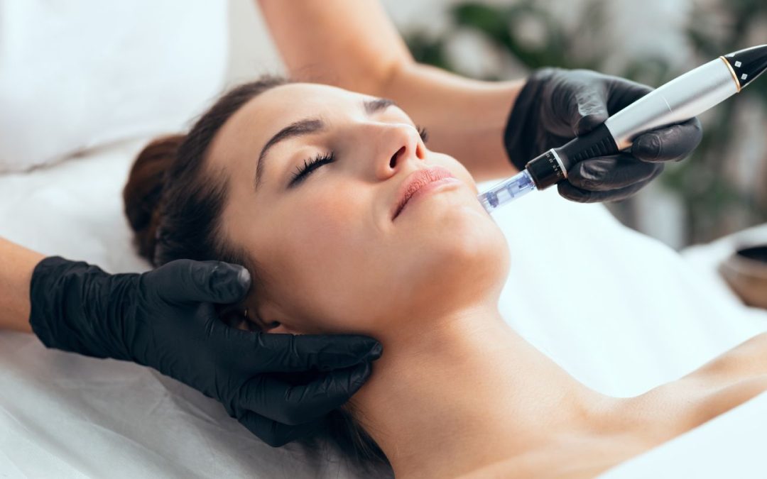 How Many Sessions of Microneedling Do I Need For Acne Scars?