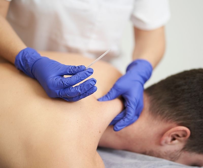 Acupuncture Treatment On Back