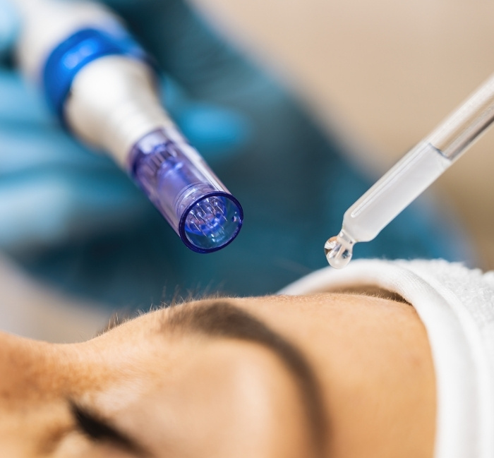 Microneedling Procedure On Forehead