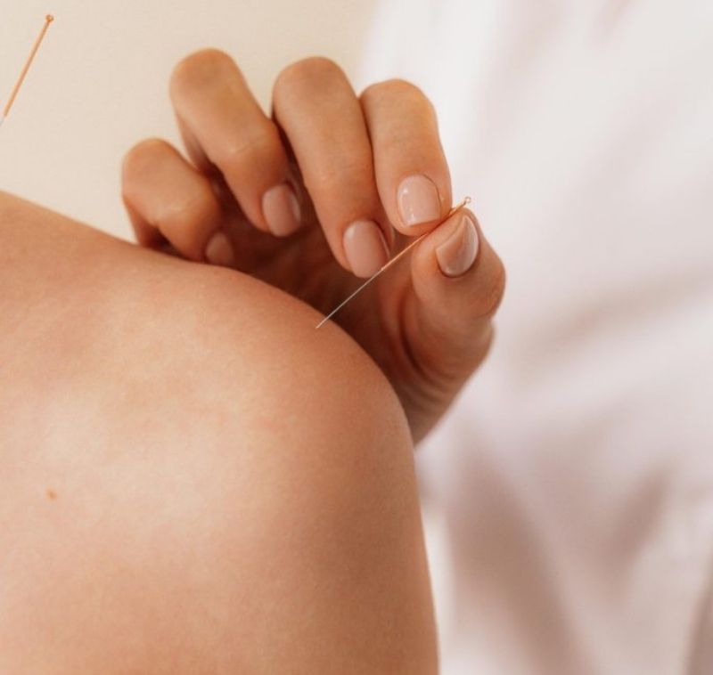 Shoulder Acupuncture Close-Up